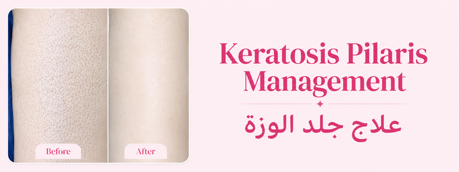Shaan Keratosis Pilaris