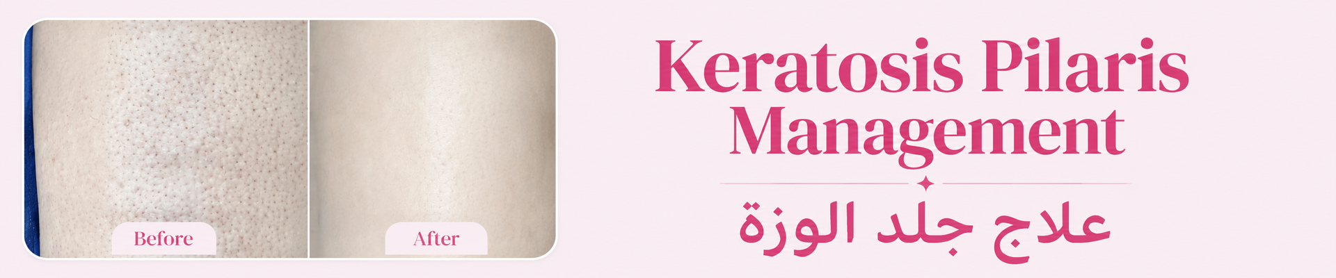 Shaan Keratosis Pilaris